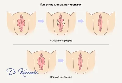 Лабиопластика (коррекция половых губ) - вся информация