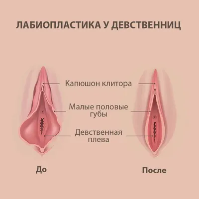 Лабиопластика в Минске | Медицинский центр Эра