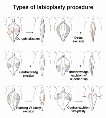 Лабиопластика – уменьшение малых половых губ в Киеве | Олтерен-Эстетик