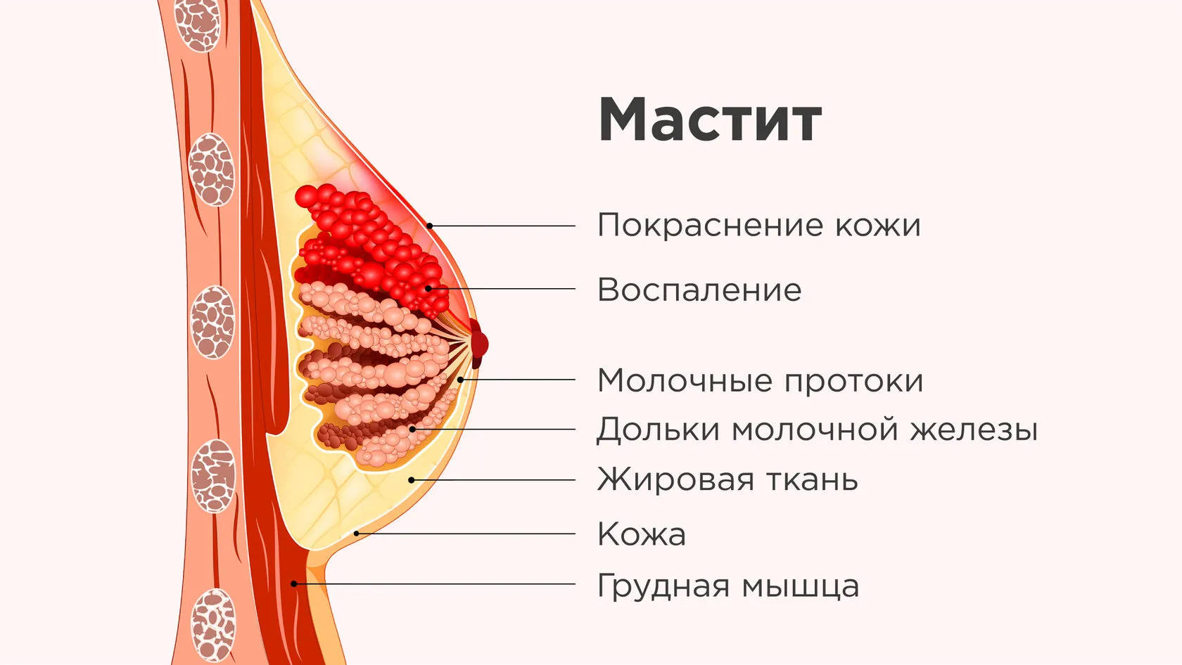 Застой молока в груди