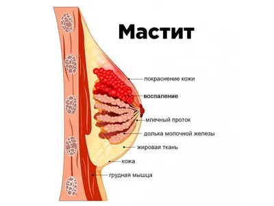 Застой молока у кормящих женщин, или лактостаз - причины появления, при  каких заболеваниях возникает, диагностика и способы лечения