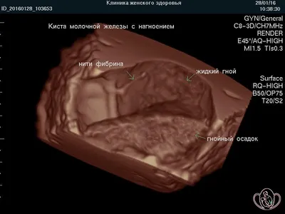 Лактостаз – симптомы, причины, диагностика и лечение заболевания, прогноз и  профилактика