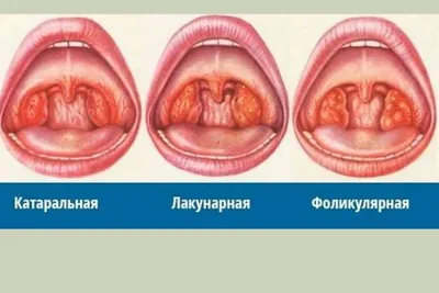 Ангина, острое воспаление миндалин