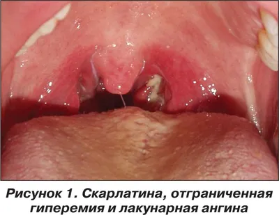 Гнойная ангина: типы, причины возникновения, симптомы, лечение заболевания