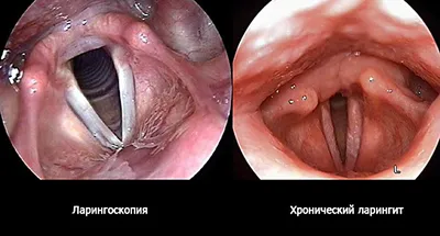 Ларингит: симптомы, лечение, острый, хронический, фото