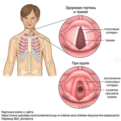 Ларингит и фарингит в чём разница? Ларингит и фарингит – это болезни горла,  чаще всего инфекционного характера. Похожие симптомы и всего одна... | By  Платная скорая помощь \"Медэкспресс\" г. Алматы | Facebook