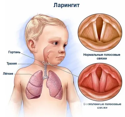 Хронический ларингит