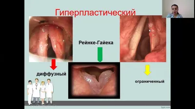 Ларингит у детей - признаки, причины, симптомы, лечение и профилактика -  iDoctor.kz