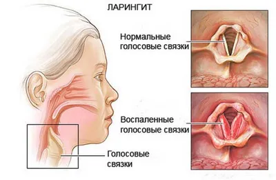 Ларингит — отличия от других заболеваний горла, методы лечения: лечение у  взрослых в домашних условиях