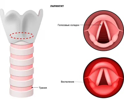 Ларингит: признаки, симптомы, лечение - МедКом