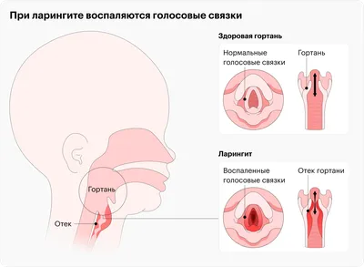 Ларингит: от чего зависит эффективность лечения — Актуальная тема