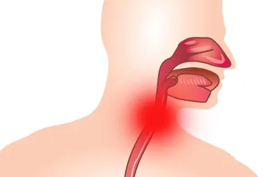 Молодая женщина подметая Laryngeal, ларингит, зоб или Hypothyreosis  Стоковое Фото - изображение насчитывающей женщина, цервикально: 142964450