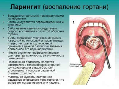 Ларингит у детей и у взрослых. Симптомы, причины, и лечение.