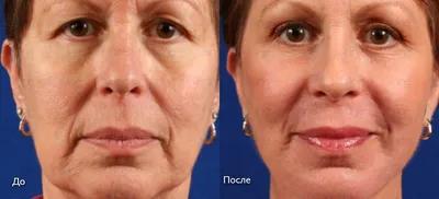 Laser resurfacing of facial skin - YouTube