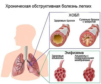 Легкие курильщика стоковое фото ©blackboard1965G 47151995