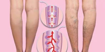 Предотвратить или лечить: откуда берется варикоз, и можно ли с ним  попрощаться навсегда | MARIECLAIRE