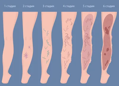 Варикоз - что такое варикоз: симптомы, стадии, способы лечения и  профилактики варикозного заболевания вен нижних конечностей