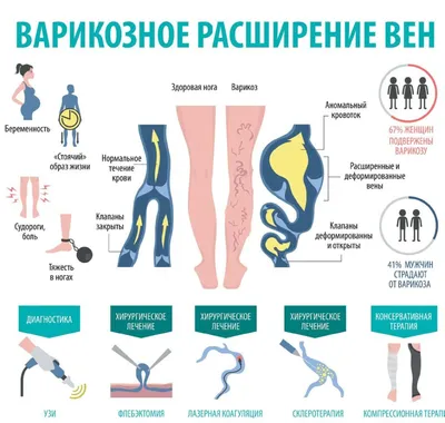 Варикоз на ногах: лечение, симптомы, профилактика