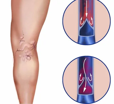 Профилактика варикоза вен на ногах