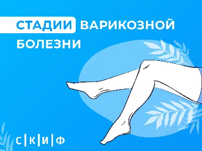 Признаки и сипмтомы варикоза у мужчин и женщин