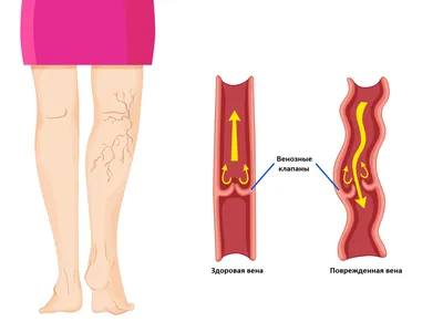Лечение варикоза лазером: самый действенный метод!