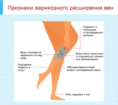 Варикоз - что это, симптомы заболевания, типы, диагностика и лечение