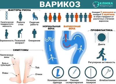 Варикоз при беременности: признаки, причины, лечение и профилактика