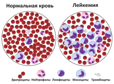 Лейкемия, или лейкоз, рак крови: острый, симптомы, лечение