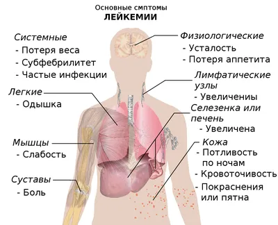 Лейкемия, или лейкоз, рак крови: острый, симптомы, лечение