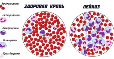 Лейкемия: симптомы, диагностика и лечение» — создано в Шедевруме