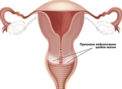 Полный порядок. Брекеты в С-Петербурге - Что такое лейкоплакия? Лейкоплакия  - хроническое заболевание слизистой оболочки полости рта, в его основе  лежит гиперкератоз эпителия (повышенное ороговение). При этом происходит  утолщение, ороговение и слущивание