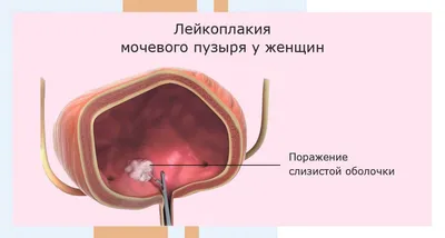 RU2665115C1 - Способ комплексного лечения крауроза и лейкоплакии вульвы -  Google Patents