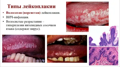 Лейкоплакия мочевого пузыря: диагностика, лечение, операции при лейкоплакии