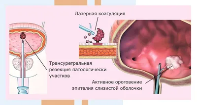 Лечение шейки матки: методы лечения, стоимость, прогнозы | ФГБУЗ Сибирский  окружной медицинский центр