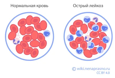 Как распознать лейкоз у ребенка. 12 признаков — в одной картинке — Meduza