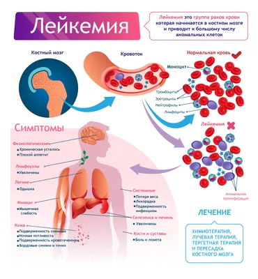 Острый лейкоз крови: симптомы, диагностика, лечение, стадии и профилактика  острой лейкемии