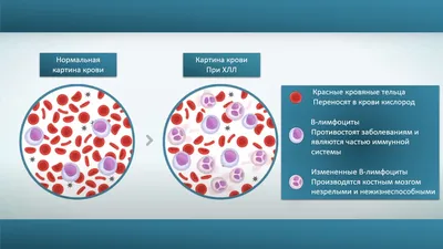 Что такое лейкоз (лейкемия): кто в зоне риска и какие признаки рака крови.  Донорство костного мозга. - 20 января 2020 - 29.ru
