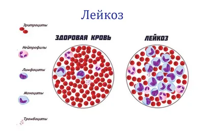 Лейкоз. Симптомы у детей | Онкология — не приговор | Дзен