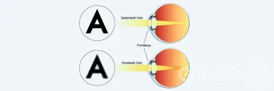 Ленивый глаз (амблиопия): что это такое? 【GlazGo】