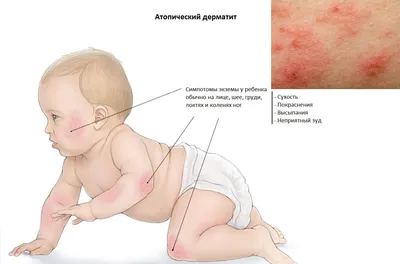 Лямблиоз у детей, лечение | Новости | As Clinic | Клиника красоты и  здоровья в Астане