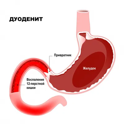 Холецистит - воспаление желчного пузыря