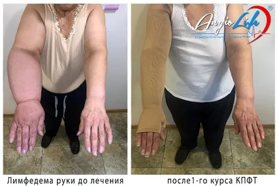 Results of treatment of lymphostasis, lymphedema | Before and after