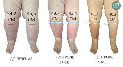Лимфедема верхних и нижних конечностей — причины, симптомы, степени, лечение
