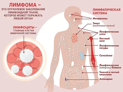 Неходжкинская лимфома