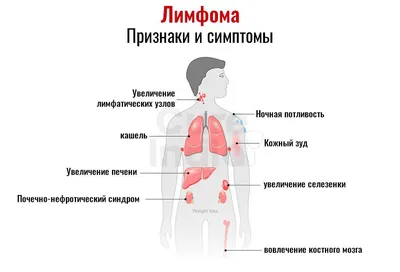 Лимфома Ходжкина у детей: что за болезнь, симптомы, причины, стадии,  лечение, прогноз [мнение онколога]