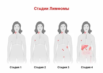 Что такое лимфома – опасна ли такая опухоль и можно ли полностью от нее  излечиться | О здоровье: с медицинского на русский | Дзен