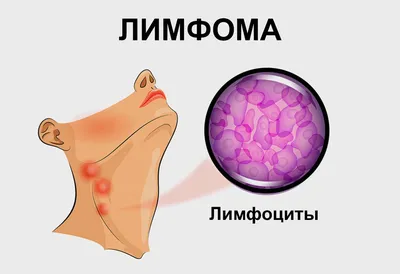 Лимфома кожи: диагностика и лечение в МЦ Лазерсвiт