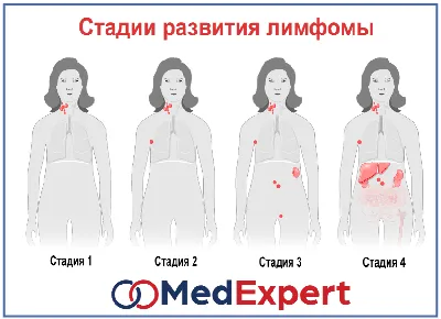 Лимфома: симптомы и признаки, стадии, прогноз, классификация, причины,  диагностика и лечение лимфом