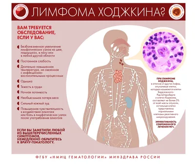 Признаки и симптомы неходжкинской лимфомы - Департамент здравоохранения  города Севастополя