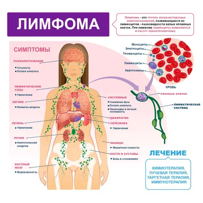 Инфографика «Признаки и симптомы неходжкинской лимфомы» - ГУЗ \"Клиническая  поликлиника № 28\"